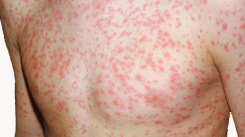 Measles patients detected in Jajarkot